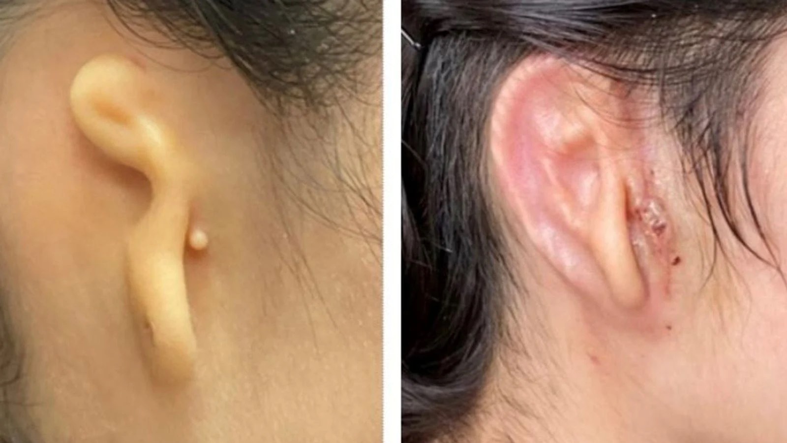 Patient before transplant left and 30 days after the procedure right Microtia Congenital Ear Institute and 3DBio Therapeutics